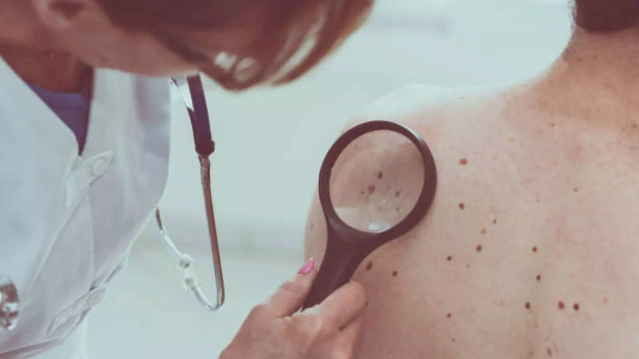 Melanoma skin cancer