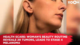 Health Scare Womans beauty routine reveals 20 tumours leads to stage 4 melanoma