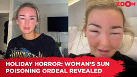 Holiday horror Womans Sun Poisoning ordeal revealed