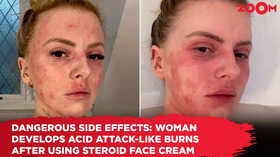 Dangerous side effects Woman develops acid attack-like burns after using steroid cream