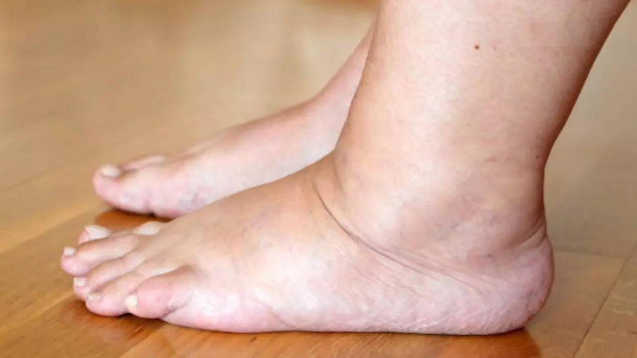Protein deficiency causes edema swelling