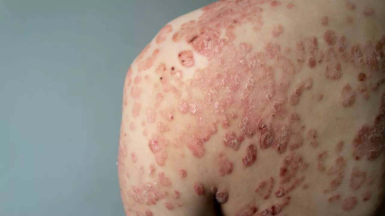 Check Here The Symptoms, Types, Triggers And Complications Of Psoriasis