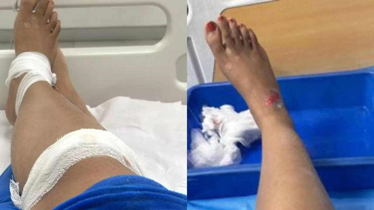 bengaluru woman says 'never taking rapido again', shares photo of injuries