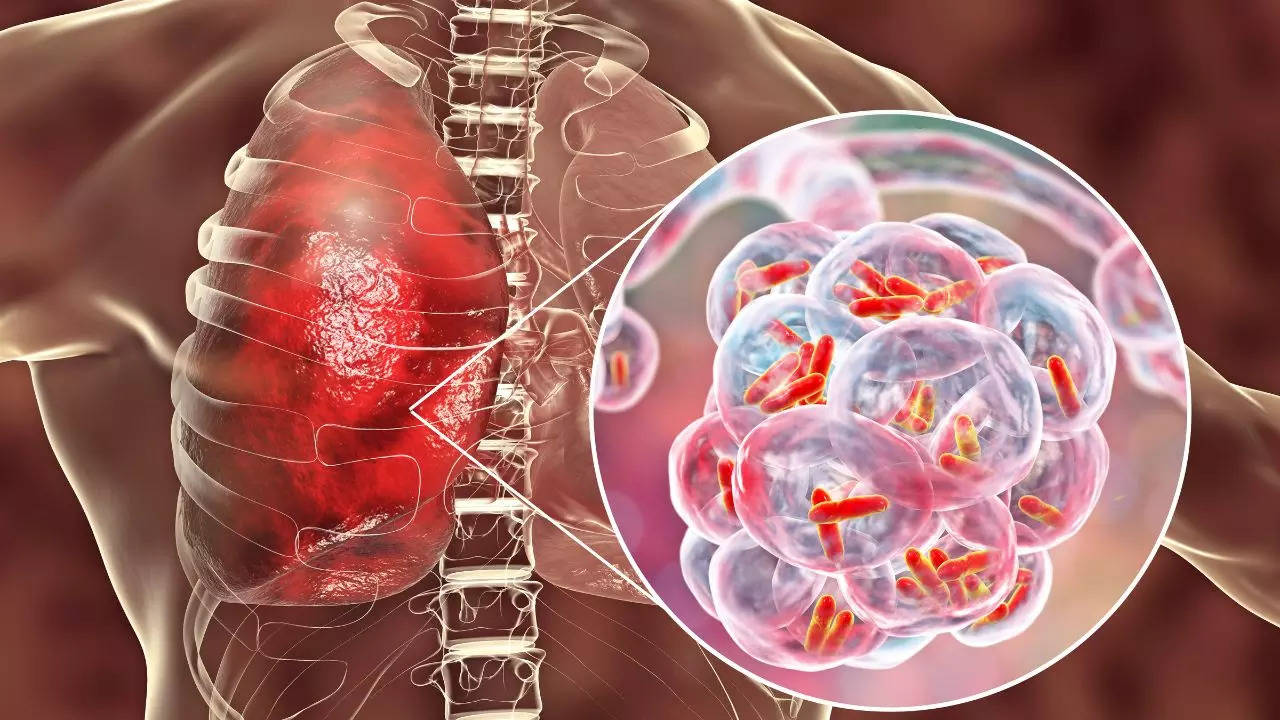 Check Here The Symptoms, Types, Complications And More About ​Pneumonia