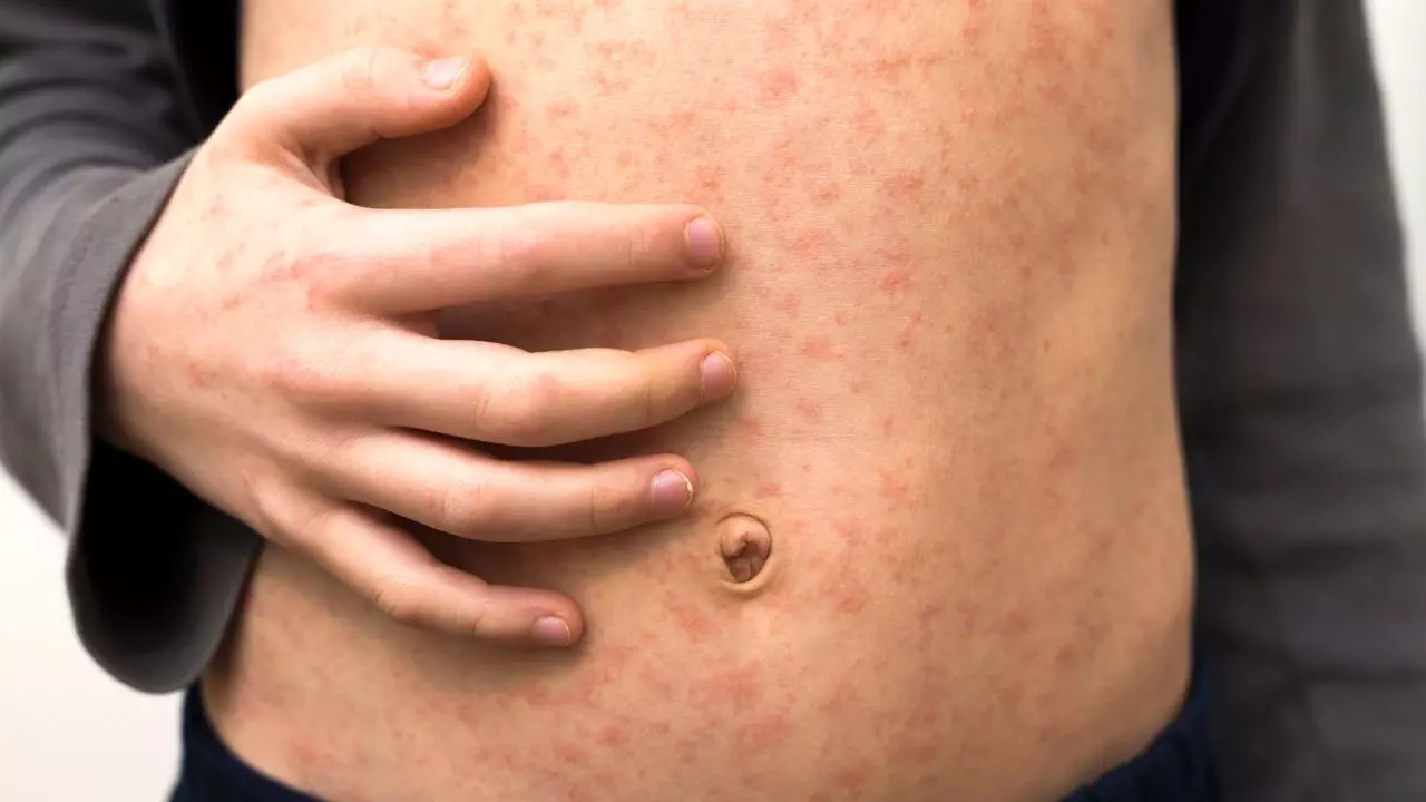 Health Alert Issued in Victoria After Measles Case Detected