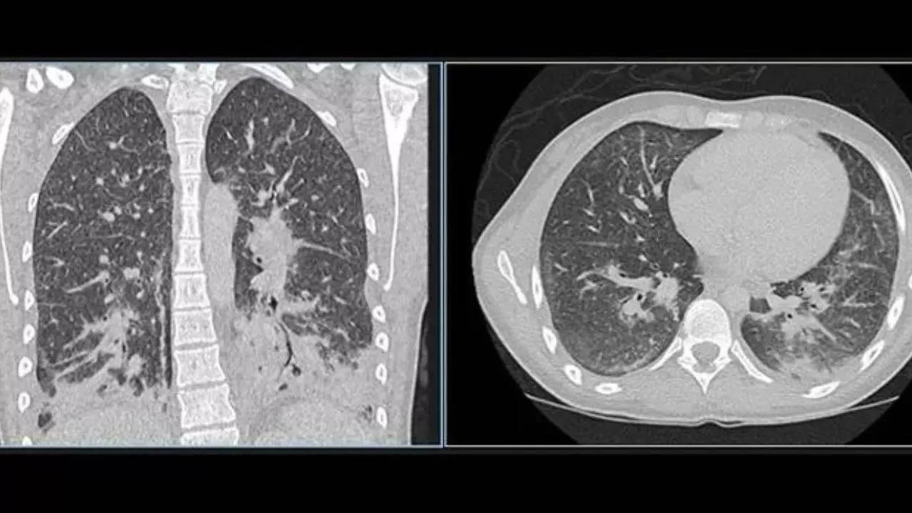 X-ray of teenager's lungs that looks like shattered glass