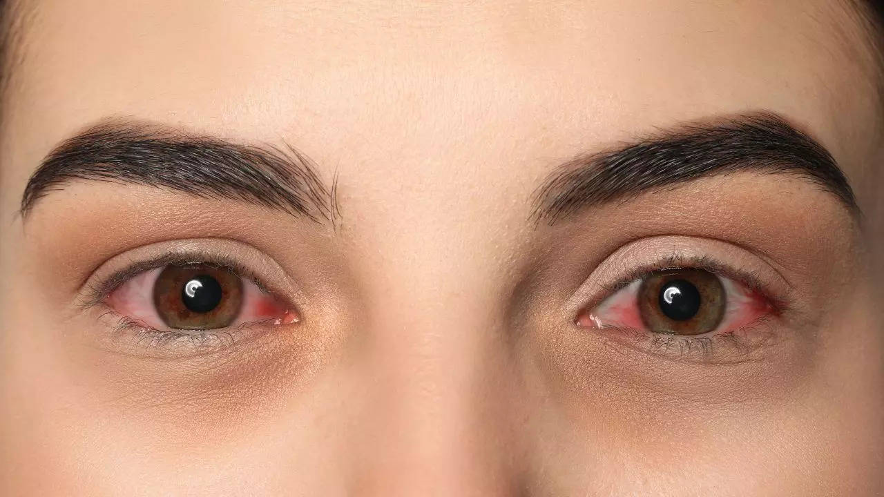 Most ​Common Eye Infections During Rainy Season​