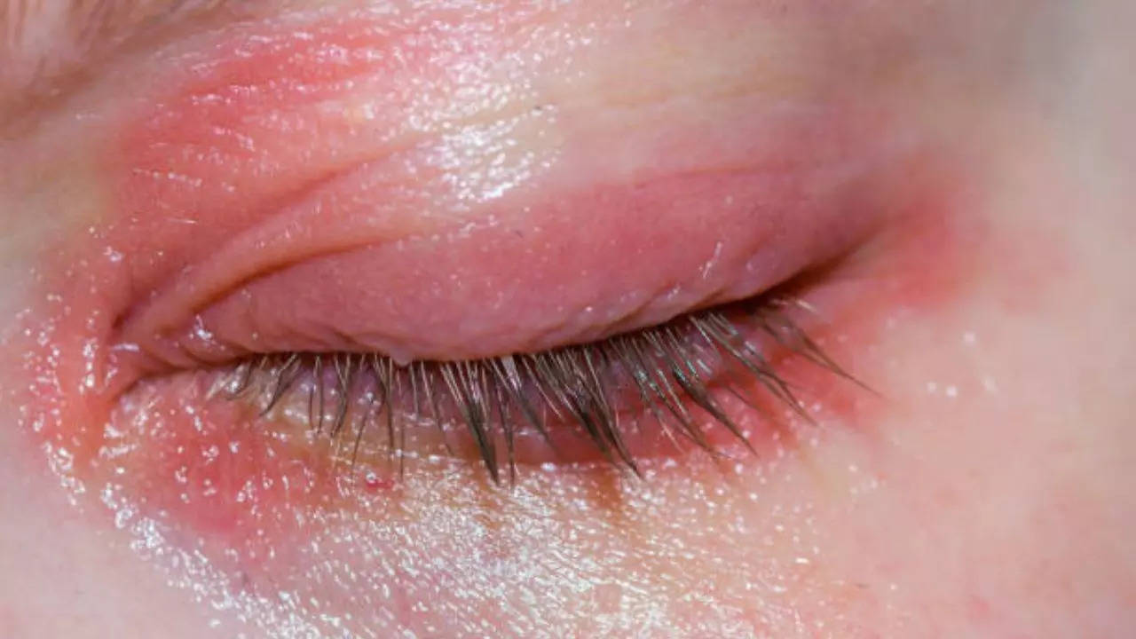 Eyelid dermatitis flares up in monsoon