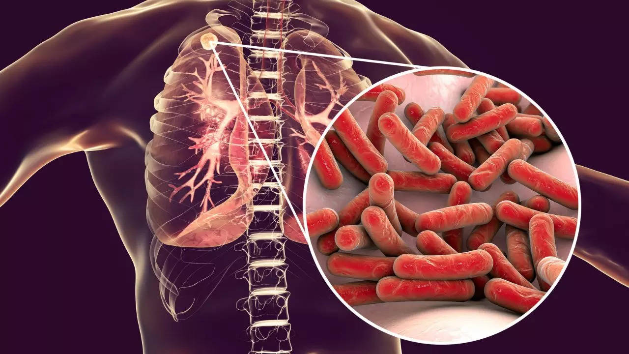 Check The Symptoms, Causes, Prevention About ​Tuberculosis