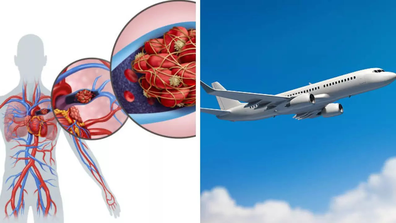 Frequent Flyers Run The Risk Of pulmonary embolism