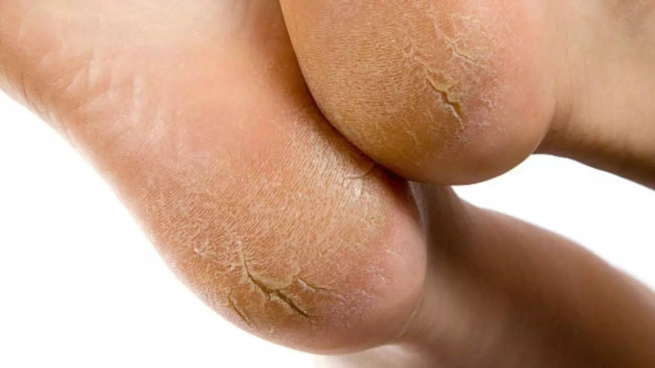 Cracked Heels Home Remedies