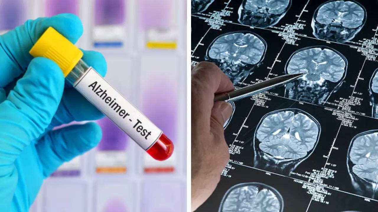 Blood tests to accurately diagnose alzheimer's