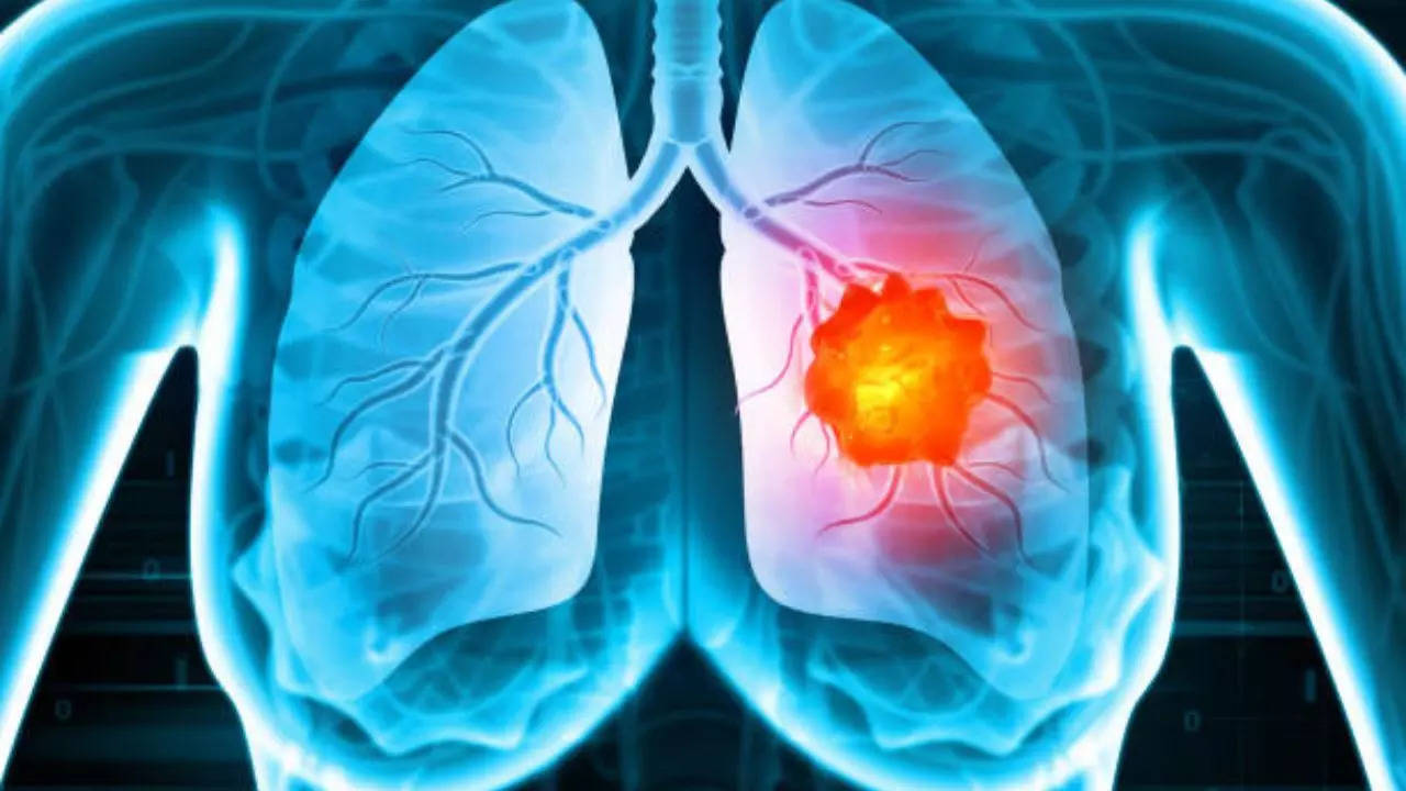 Warning signs of lung cancer