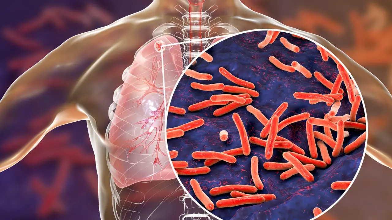 Strains Of Tuberculosis That Are Most Infectious​