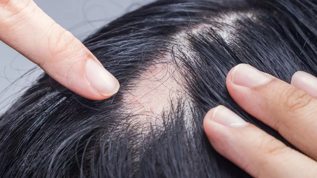 International Alopecia Day 2024: Symptoms and causes of this condition International Alopecia Day 2024: Symptoms and causes of this condition