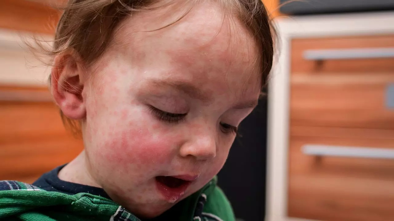 ​Why Is It Important To Protect Children From ​Measles