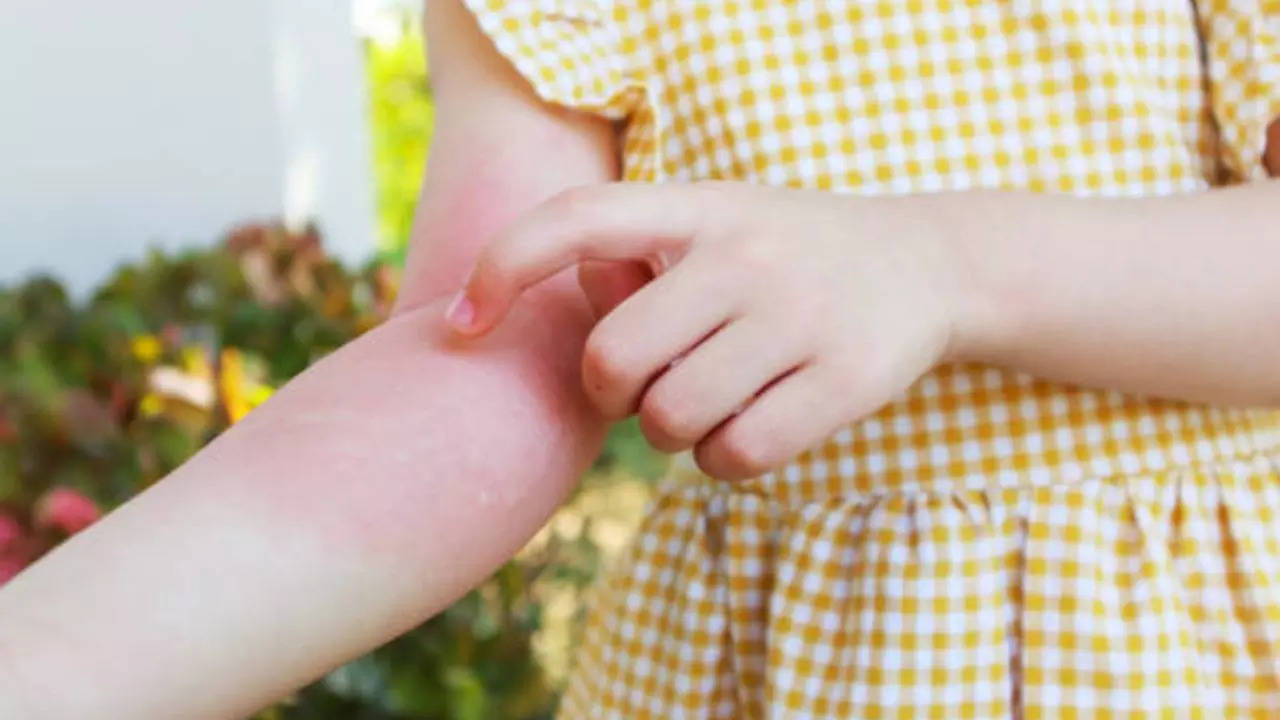 Juvenile Psoriatic Arthritis: Expert Shares Connection Between Red Rash and Joint Inflammation