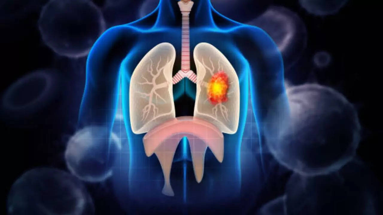 Signs That Lung Cancer Has Spread To Your Brain 