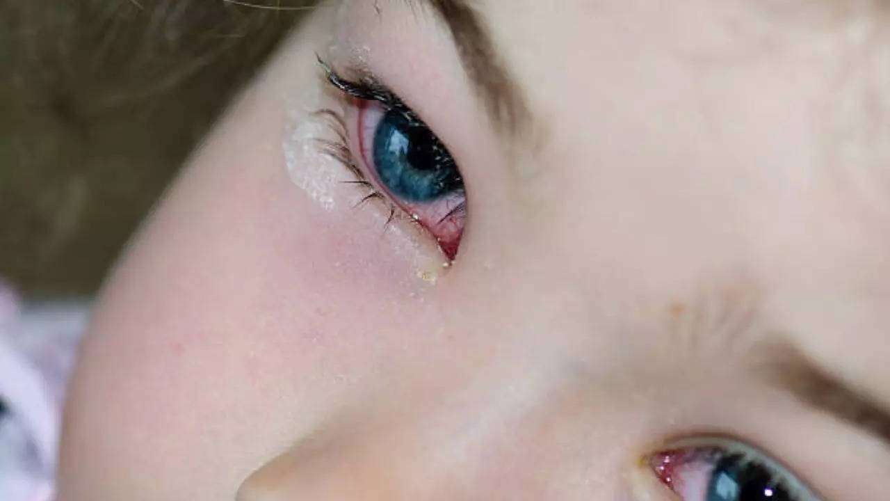 Why are children prone to conjunctivitis or pink eye