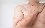 CDC Issues Alert On The Spread Of Severe Mpox Strain In Africa Signs And Symptoms To Keep A Check On