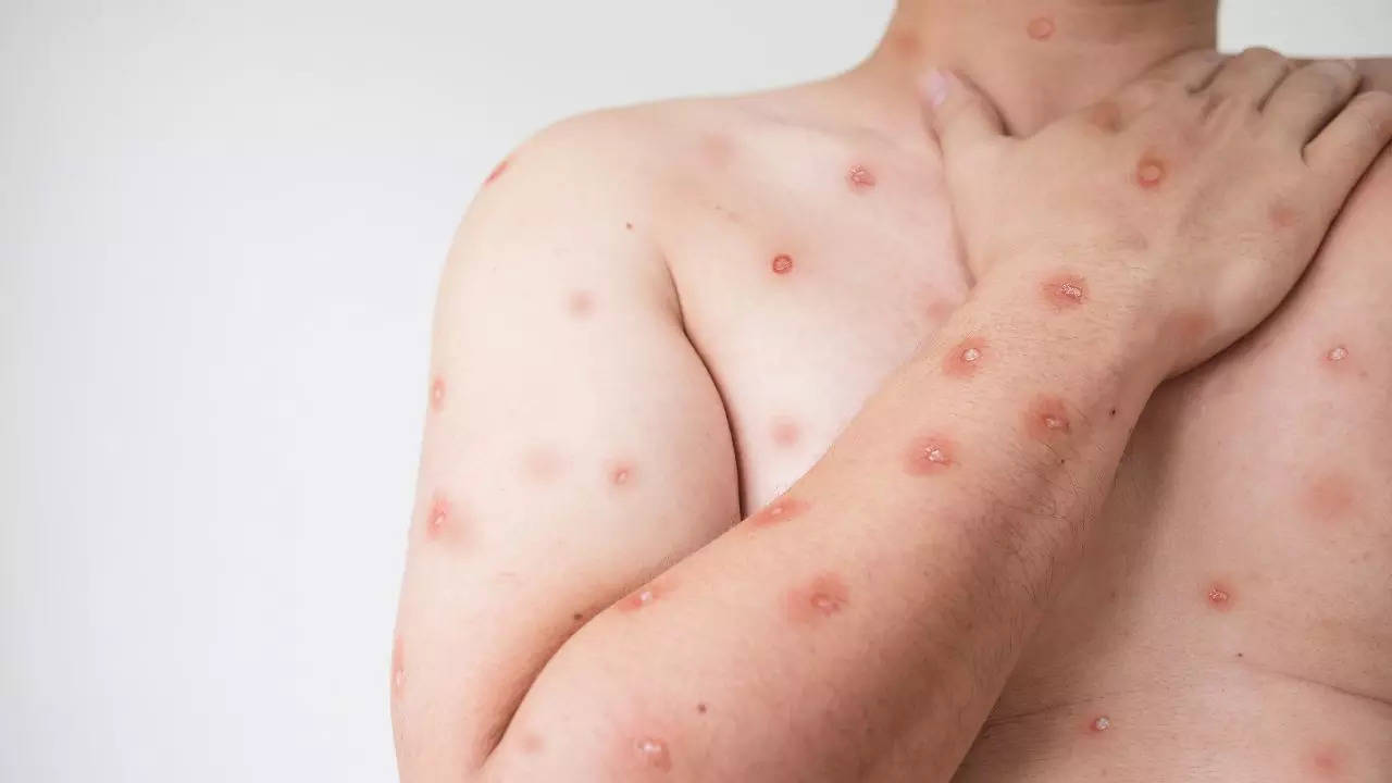 CDC Issues Alert On The Spread Of Severe Mpox Strain In Africa