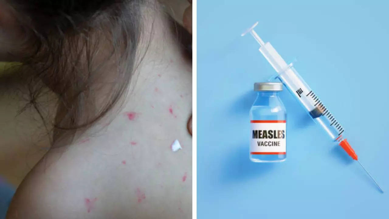 US grapples with largest measles outbreak