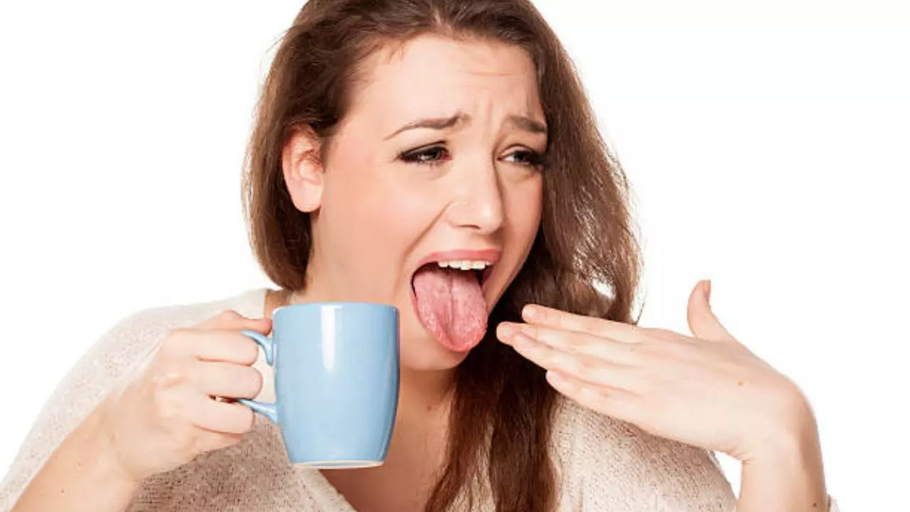 Burnt Your Mouth After Having Hot Food? Home Remedies That May Help Alleviate Pain