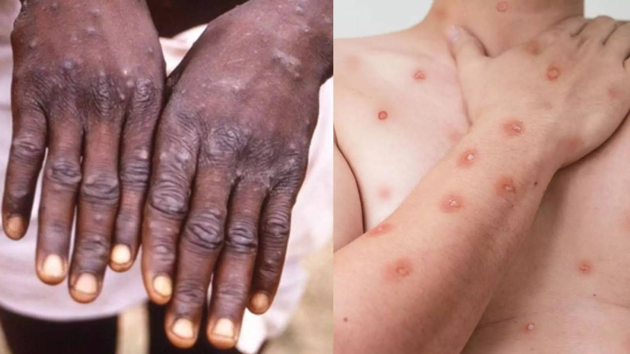 mpox‌, new virus emerges post covid, three cases in pakistan, who declares global health emergency