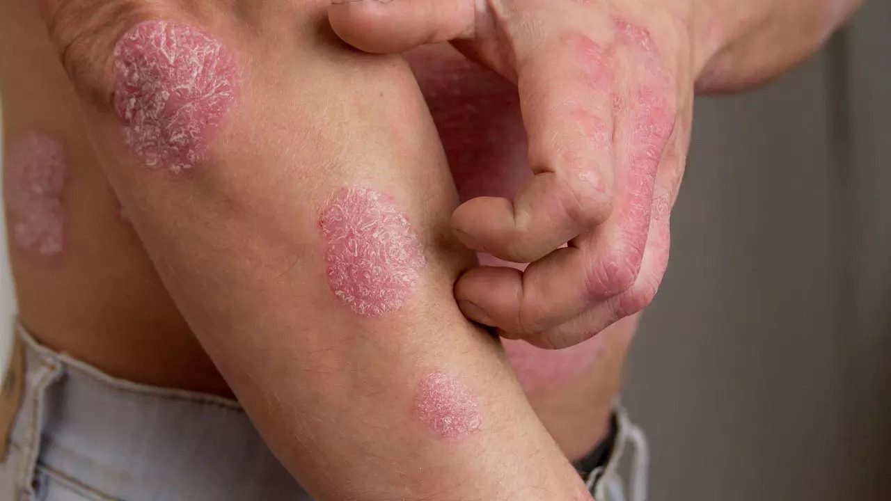 Factors That Can Trigger Psoriasis​ Flare-Ups