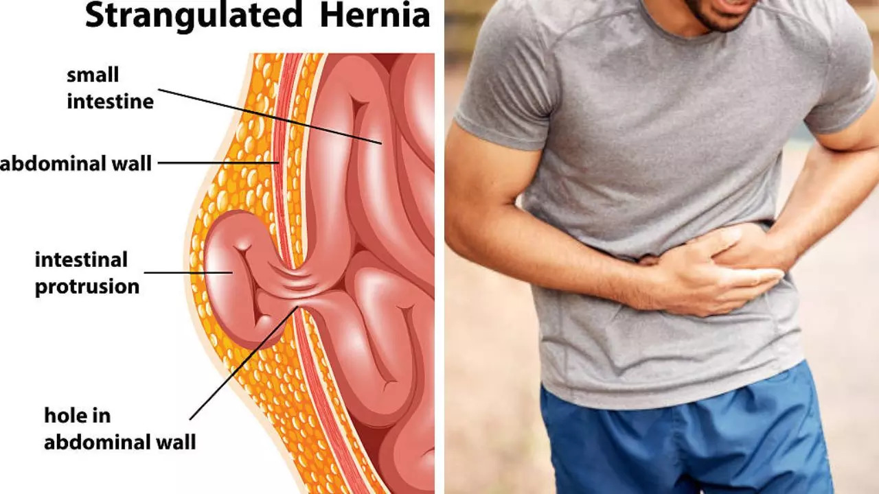 Signs and symptoms of hernia you need to watch out