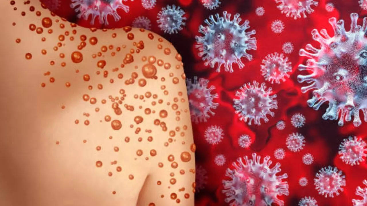 ​Mpox Outbreak: Know What You Can Do To Keep Yourself Protected​