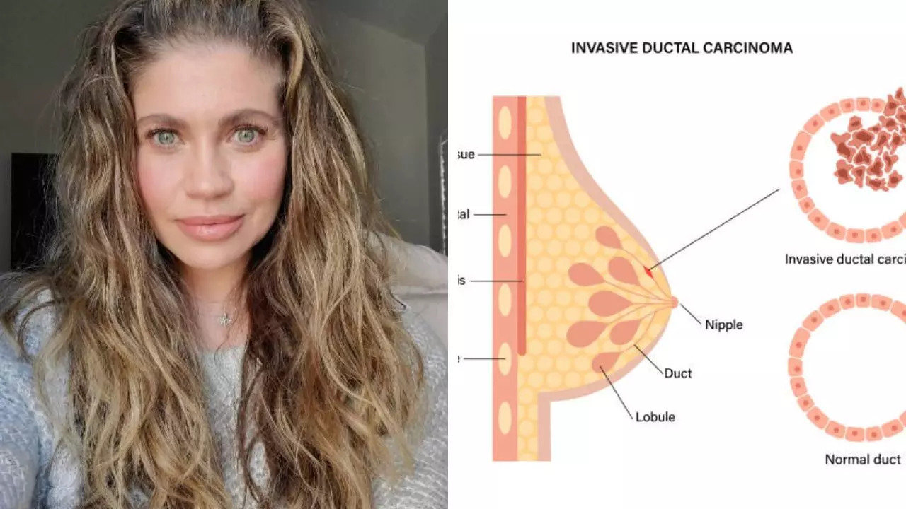 What is stage zero breast cancer which danielle fishel has 