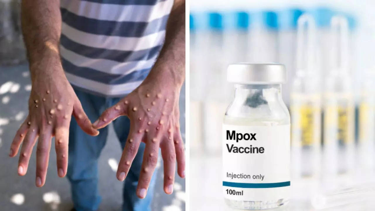 US experts call for vigilance against the new Mpox subtype