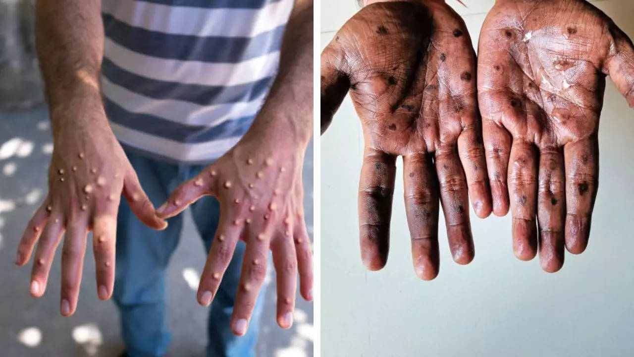 Mpox reaches thailand as Clade 1B strain now infects six countries