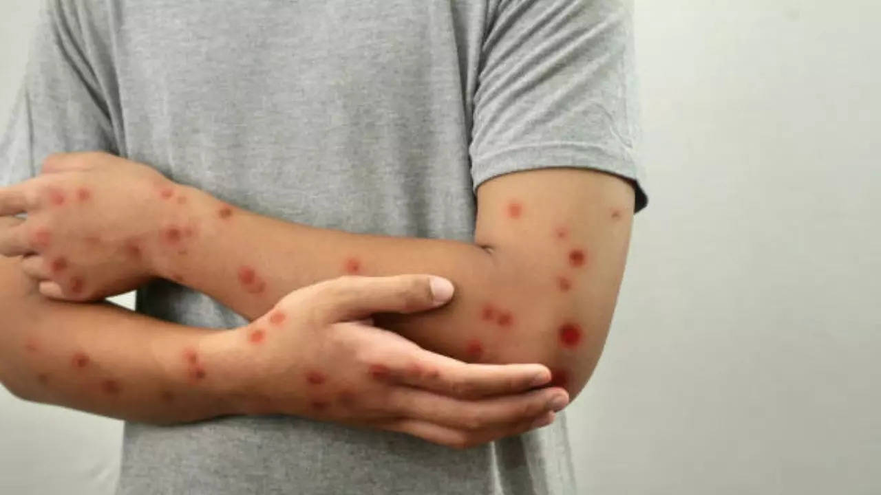 Mpox Outbreak: Expert Debunks Myths Around The Viral Disease