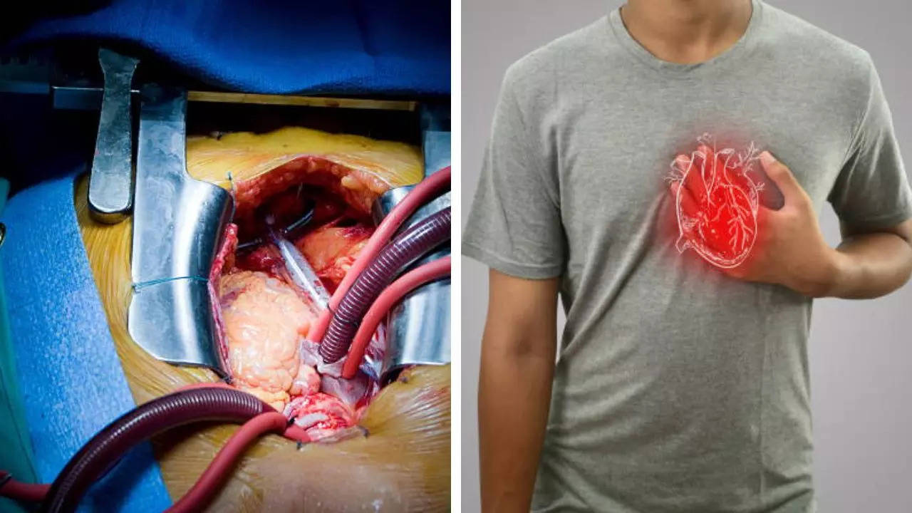 What Is The Difference Between A Bypass And An Open Heart Surgery