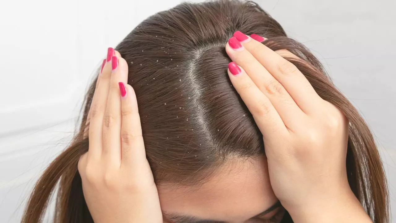 Home remedies for dandruff: Simple home remedies to prevent dandruff during monsoon