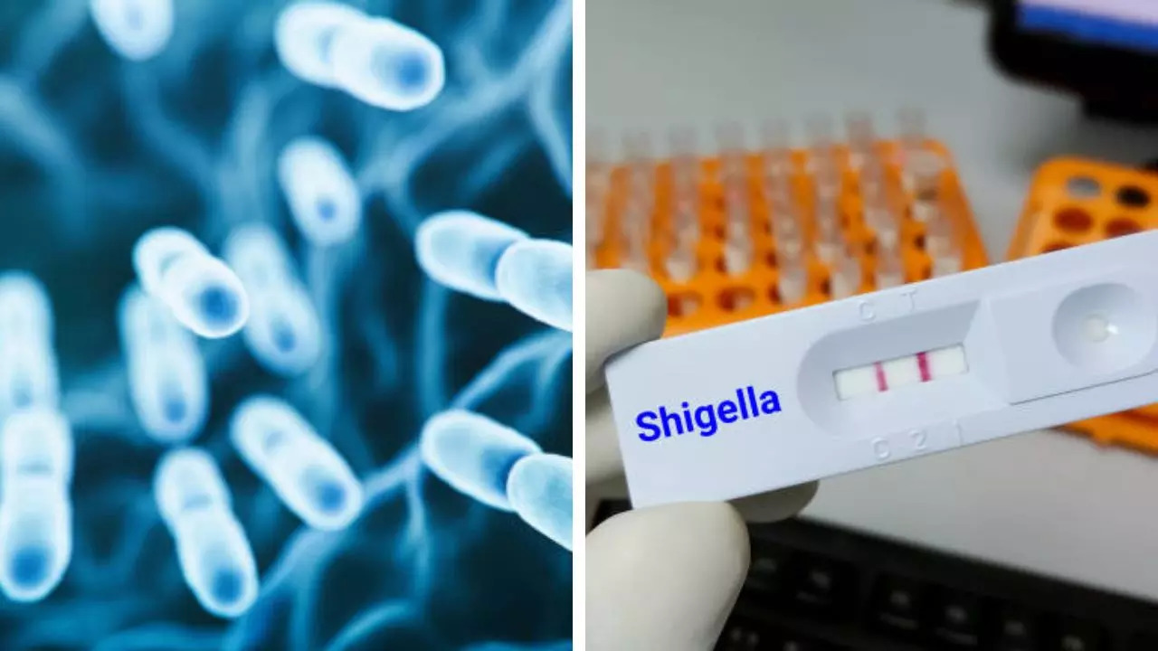 New Cases Of Shigella Outbreak Reported Among Homeless In Santa Clara