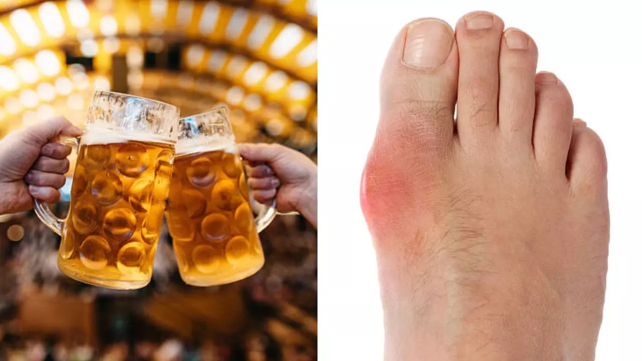 Drinking beer, champagne increases  risk of developing painful gout