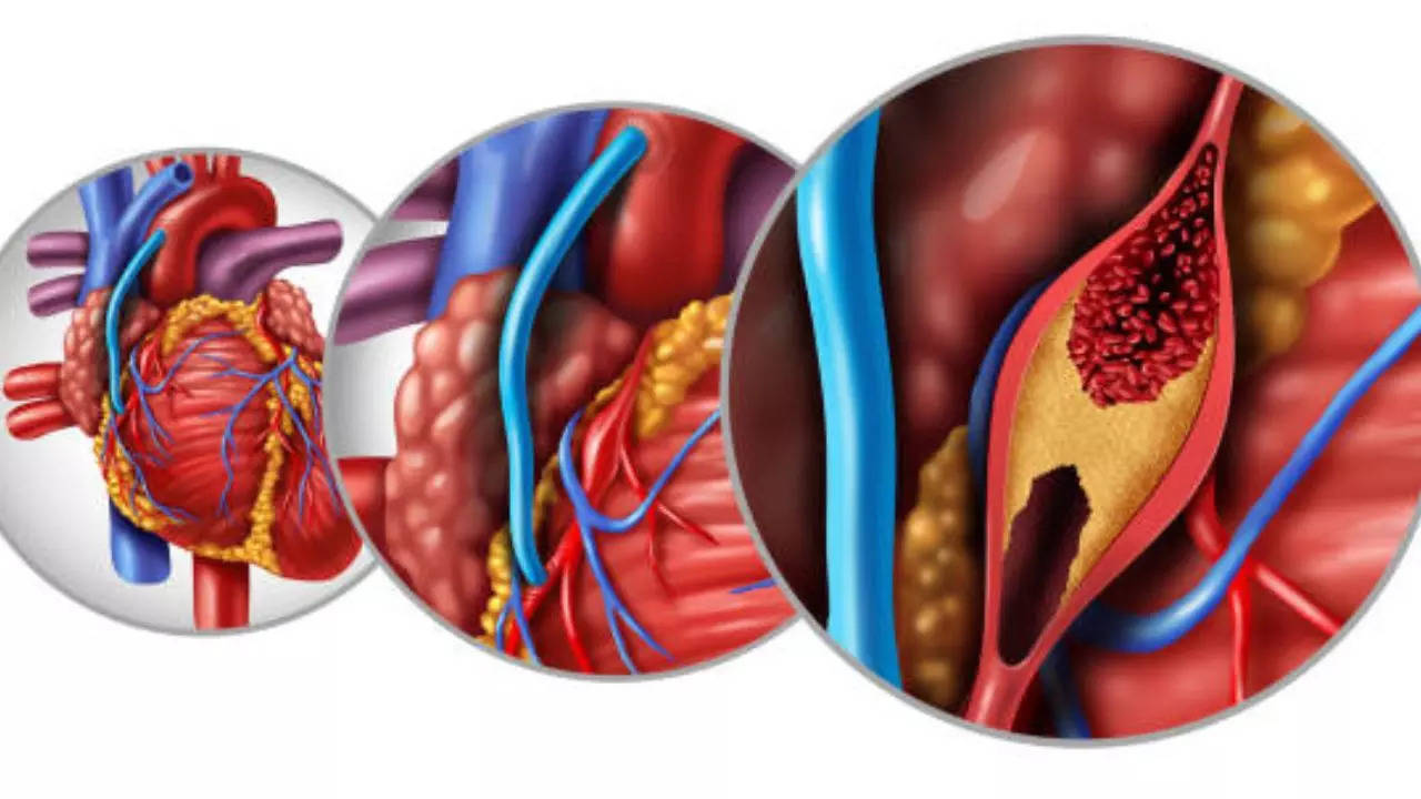 Bypass Heart Procedure Offers Hope For Elderly With Co-Morbidities; Know How It Treated A 90-Year-old With Prostate Cancer