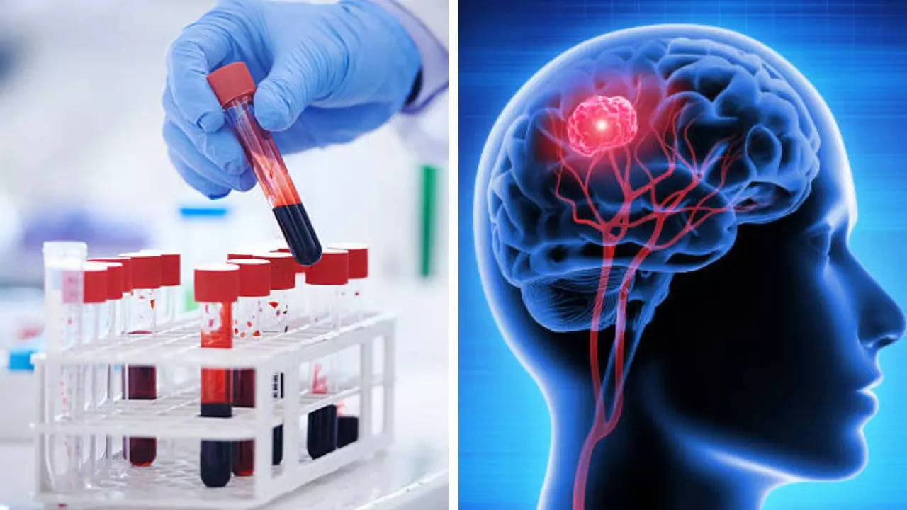 New blood test detects brain cancer in just one hour