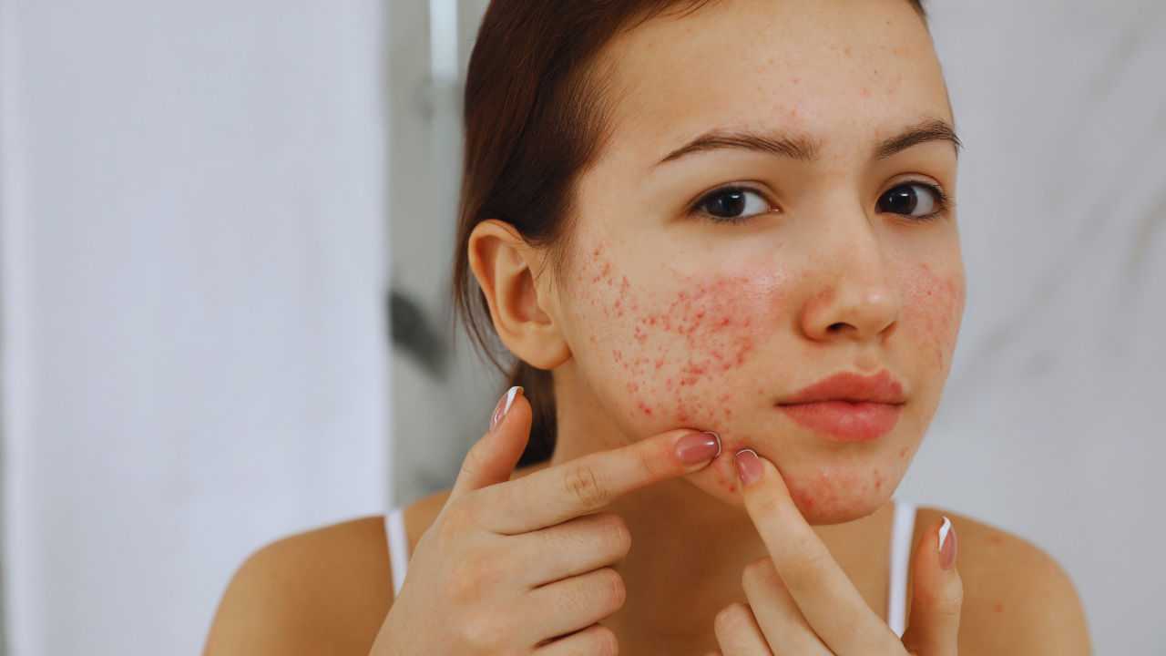 6 skincare changes that can vanish your acne in no time