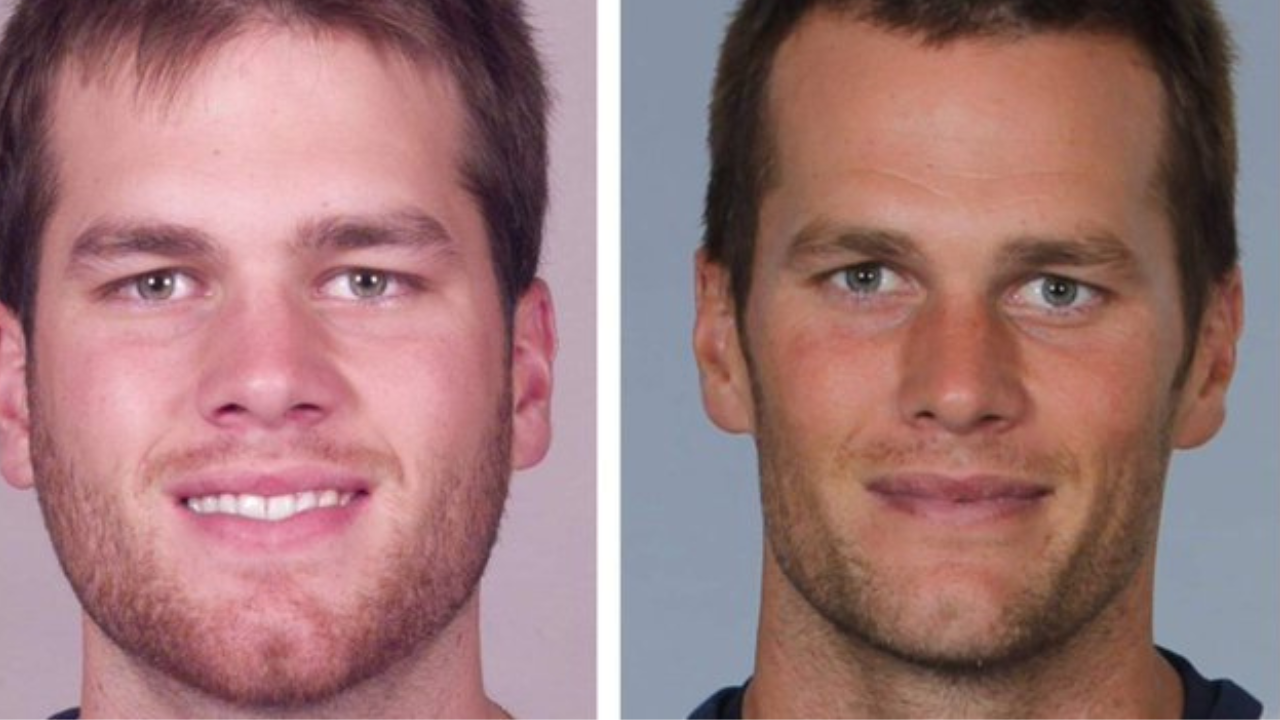 Tom Brady Plastic Surgery And Botox Rumors Resurfaced