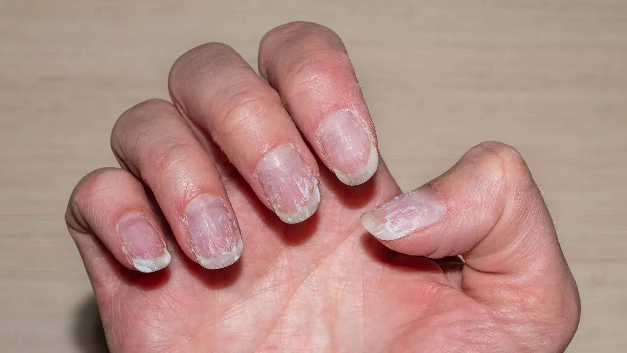 Nail Health Warning Signs these signs will indicate massive health problem