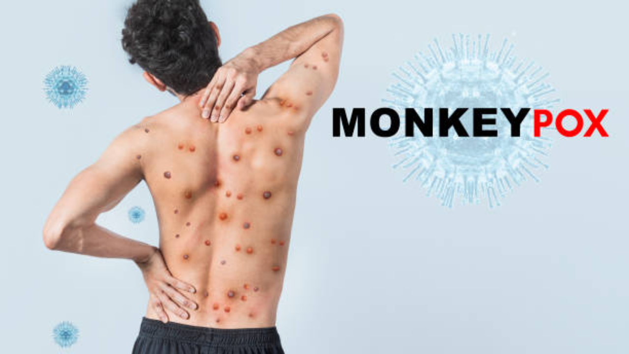 Symptoms of monkey pox