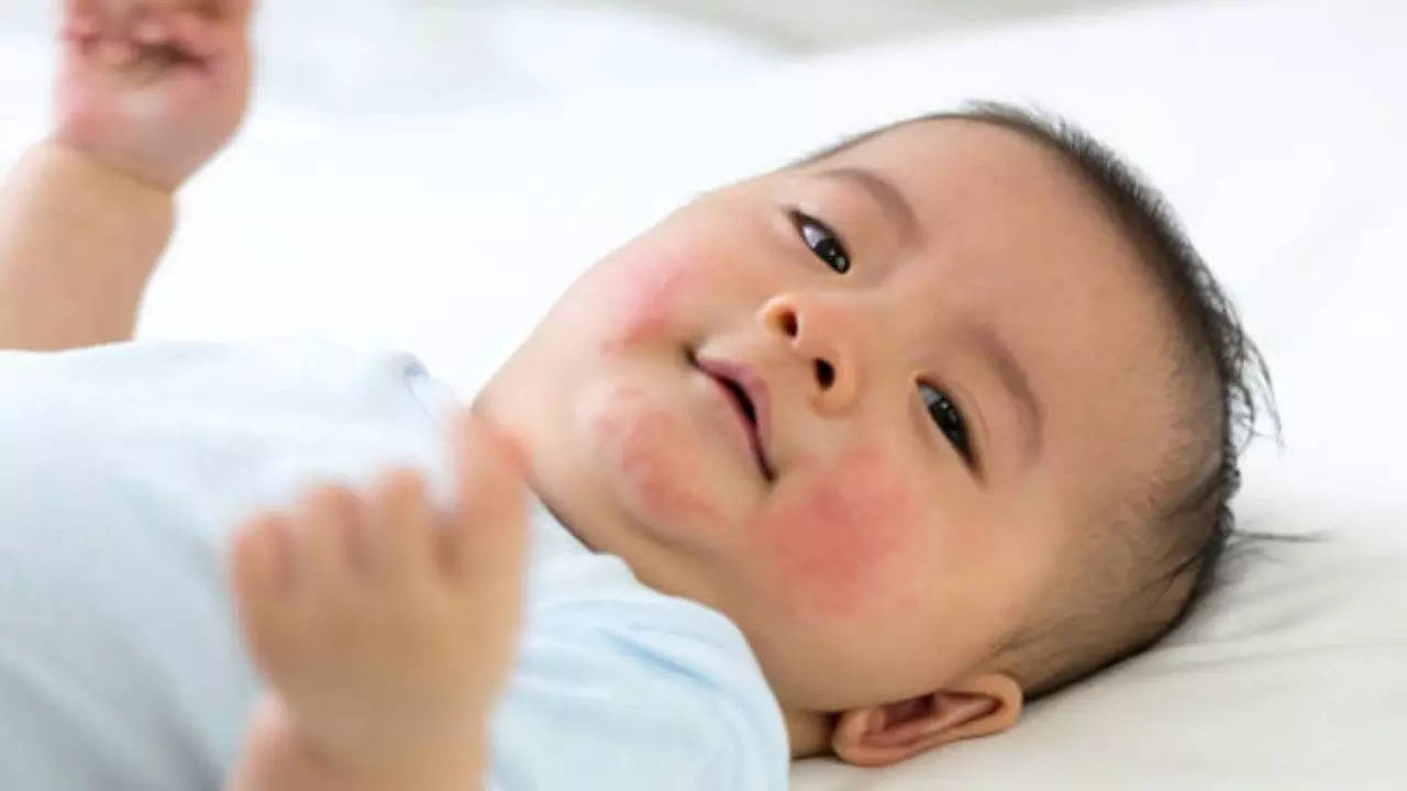 Babies Born In THESE Months Are At A Higher Risk Of Food Allergies