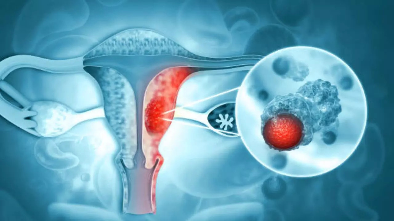 Is Vaginal Discharge A Typical Symptom of Uterine Cancer