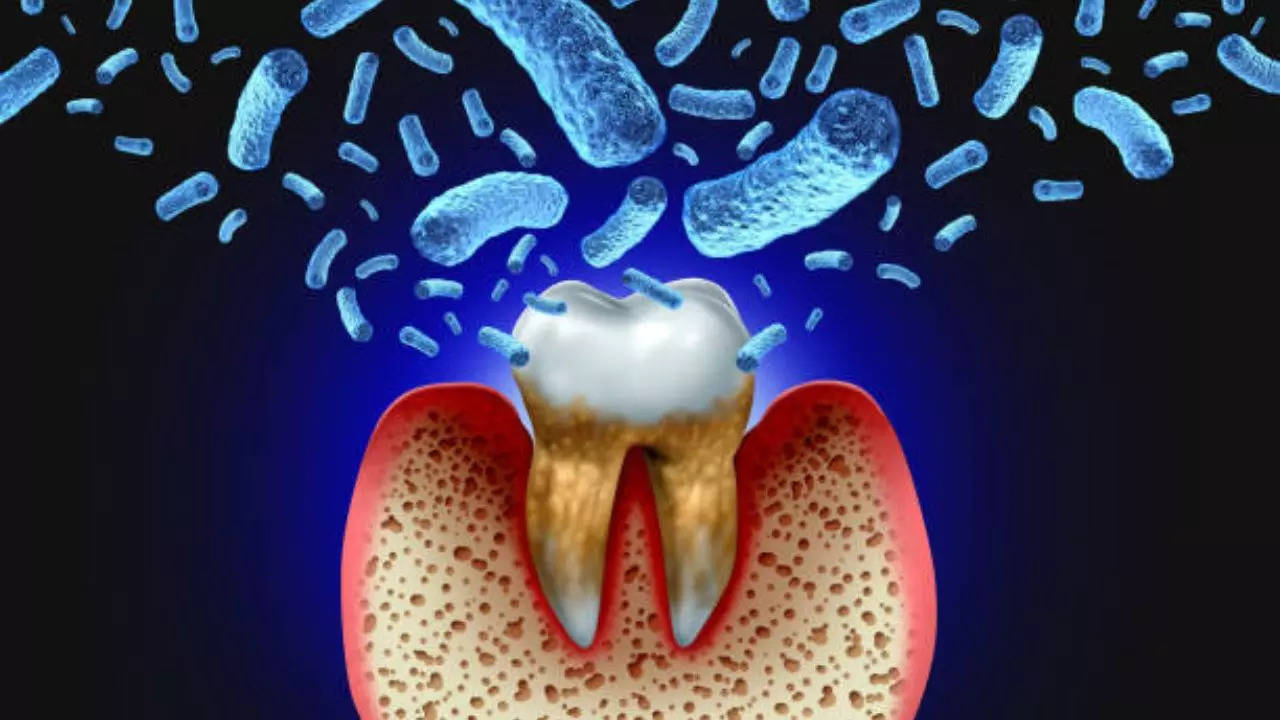 Gum Disease Germs Could Help Trigger Cancer 