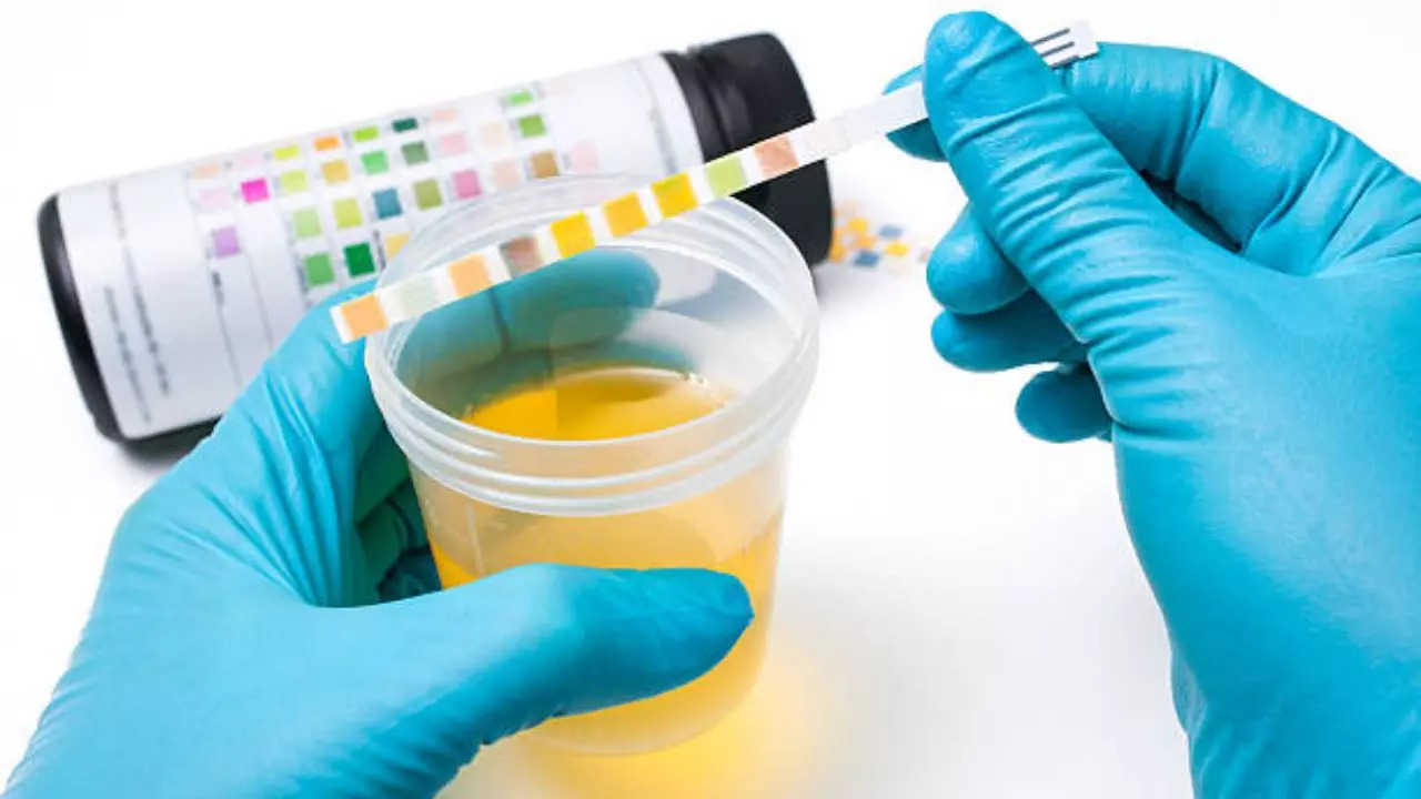 What Does Your Urine Colour Say About Your Kidney Health? Know Here