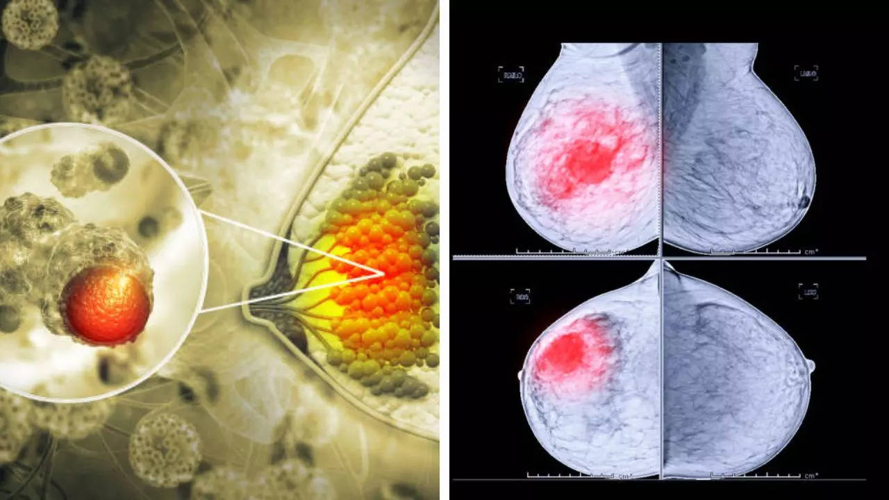 Shorter Course of Radiation Therapy For Breast Cancer Is Safe